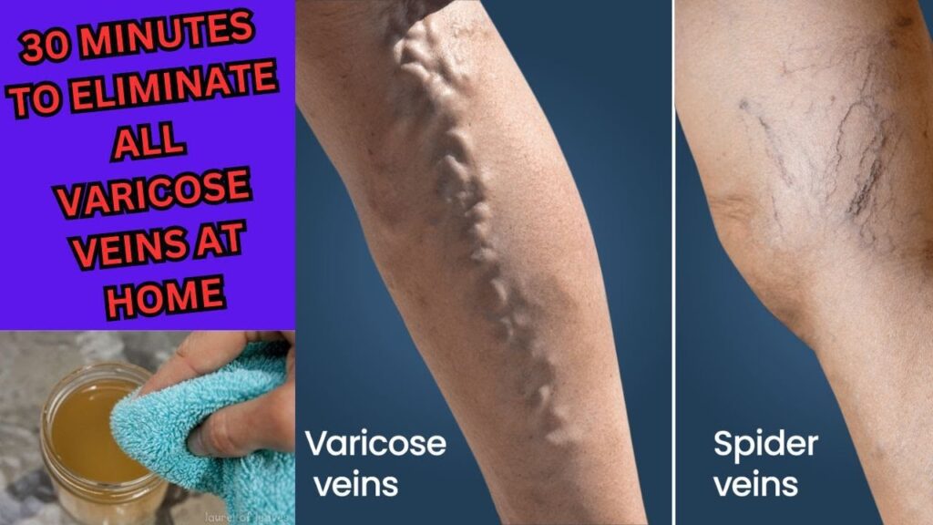 Rub This On Your Varicose Veins And They Will Disappear From Your Skin In a Few Days.