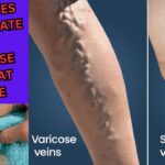 Rub This On Your Varicose Veins And They Will Disappear From Your Skin In a Few Days.