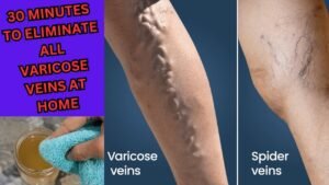 Rub This On Your Varicose Veins And They Will Disappear From Your Skin In a Few Days.