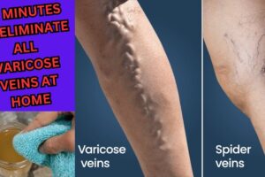 Rub This On Your Varicose Veins And They Will Disappear From Your Skin In a Few Days.