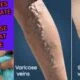 Rub This On Your Varicose Veins And They Will Disappear From Your Skin In a Few Days.